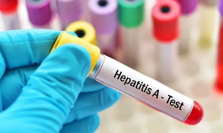 Aumento de casos de hepatitis A en Argentina alerta a las autoridades sanitarias