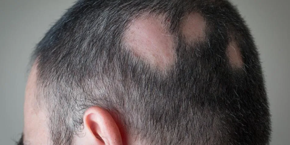 La FDA aprueba la primera pastilla para tratar la alopecia areata severa y mejorar el crecimiento del cabello